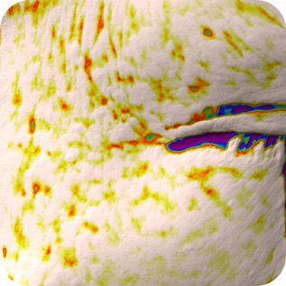 Trước, Wrinkle in Eye Area