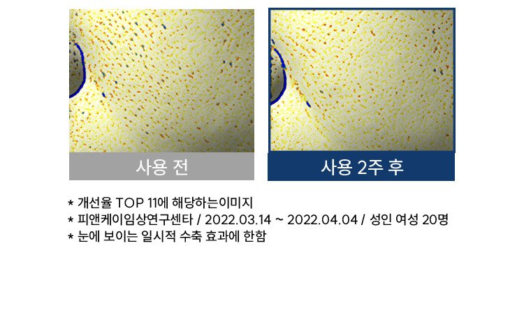 사용 전, 사용 2주 후 모공 수축 -30%*