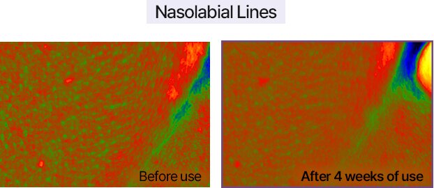 Nasolabial Lines