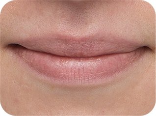 model's lips using 'BOUNCY & FIRM LIP TREATMENT' after 4 weeks