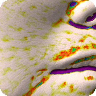 Sau 4 tuần. of use, Anti-wrinkle Effect in Smile Lines