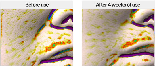 Anti-wrinkle Effect on Nasolabial lines/Perfect Renew 3X Perfect Renew 3X Emulsion